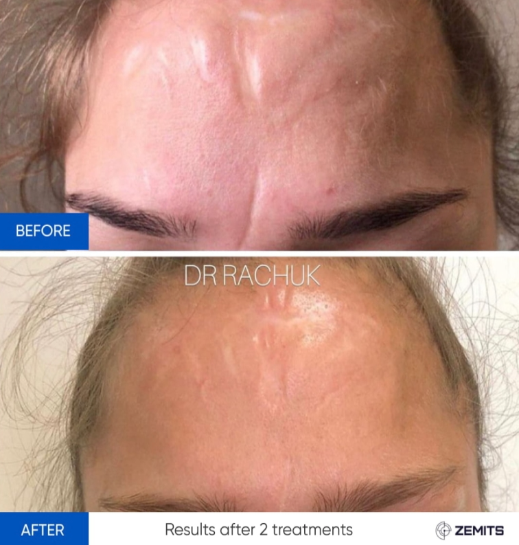 Zemits CarbonFrax Pro: CO2-Fraktionallaser