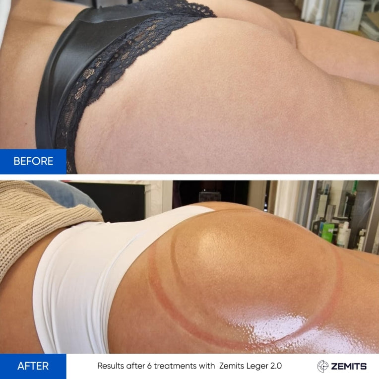 Zemits Leger 2.0 Vakuum-Schröpf-System mit XXL-Bechern im Set