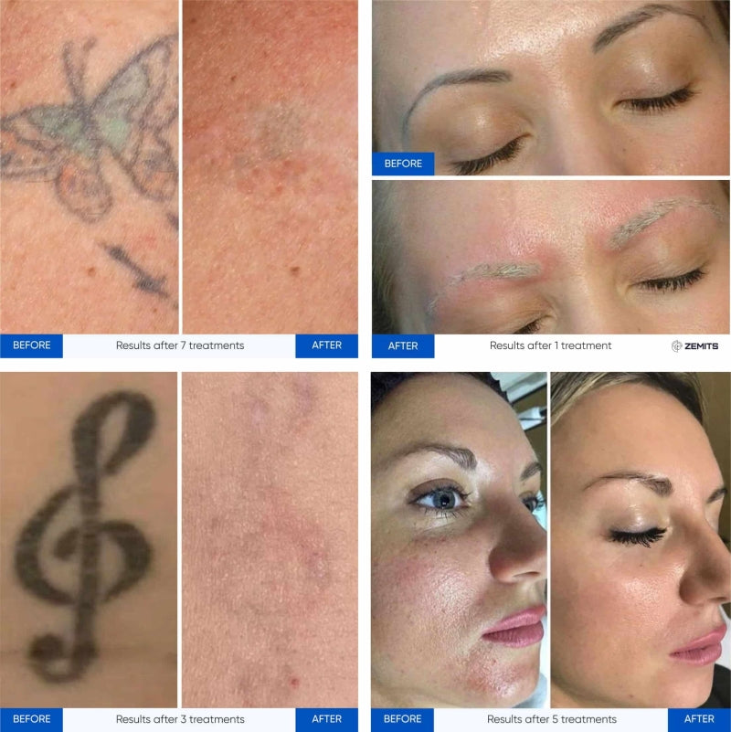 Zemits YAGenix Q-geschalteter Nd:YAG-Laser