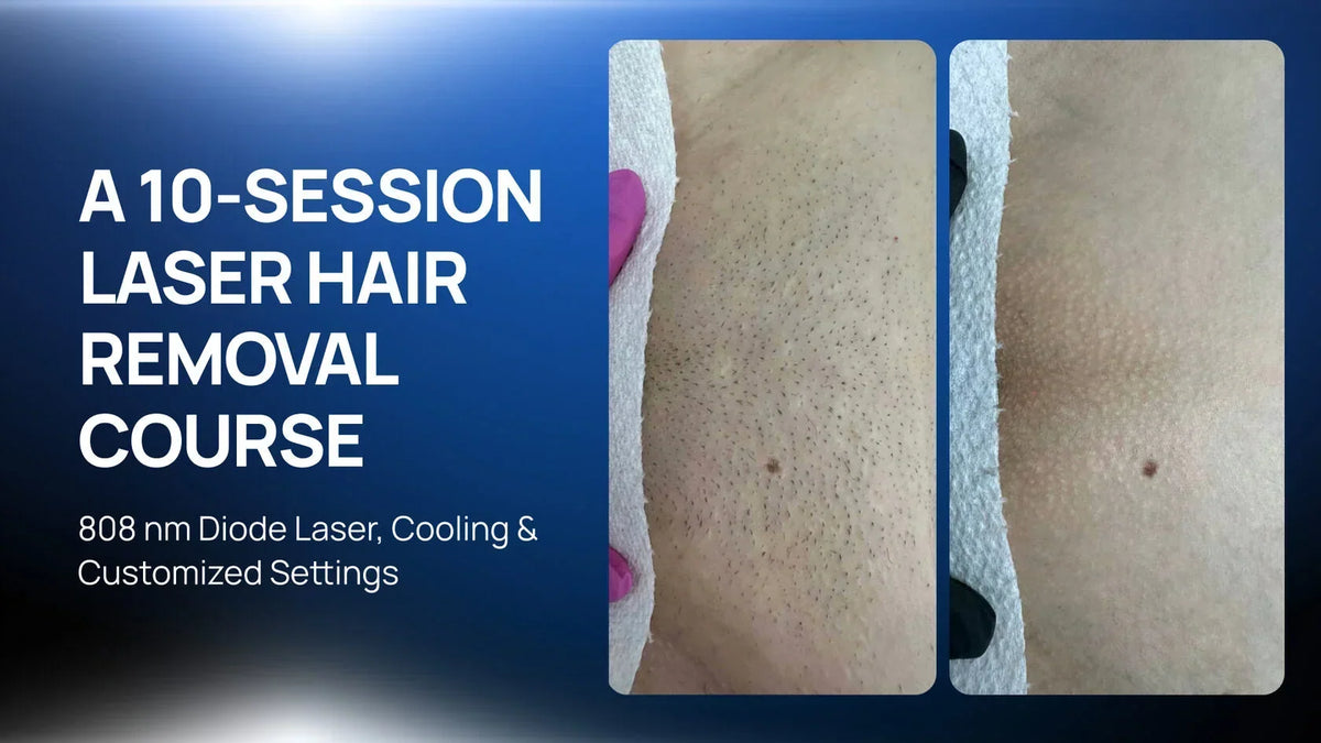 Laser Hair Removal for Ingrown-Prone Skin: an 8-Session Course for Fitzpatrick Skin Type IV