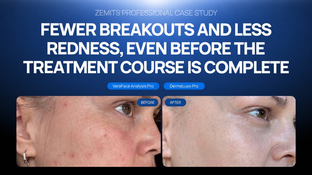 Case: Fewer breakouts and less redness, even before the treatment course is complete