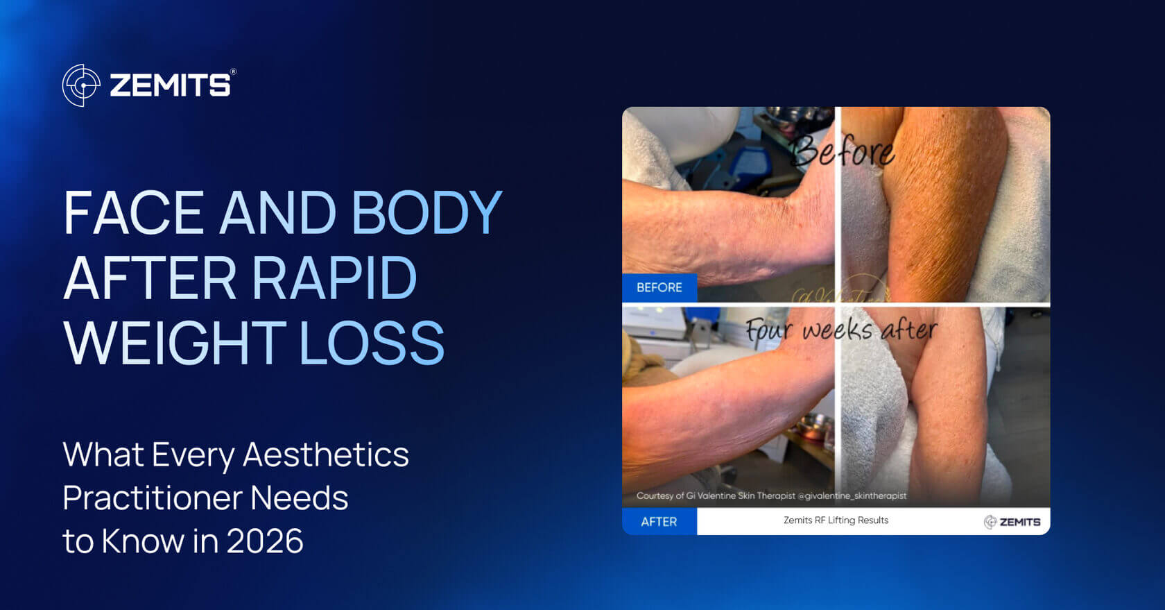 Face and Body After Rapid Weight Loss: What Every Aesthetics Practitioner Needs to Know in 2026