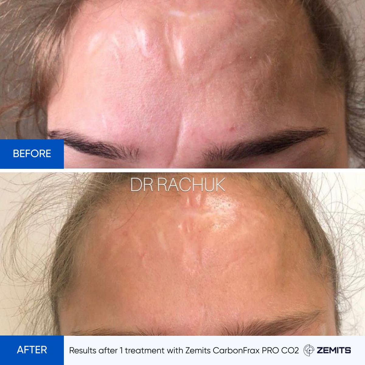 Before After Slide 1