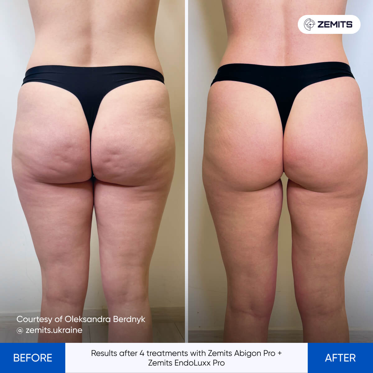 Before After Slide 3