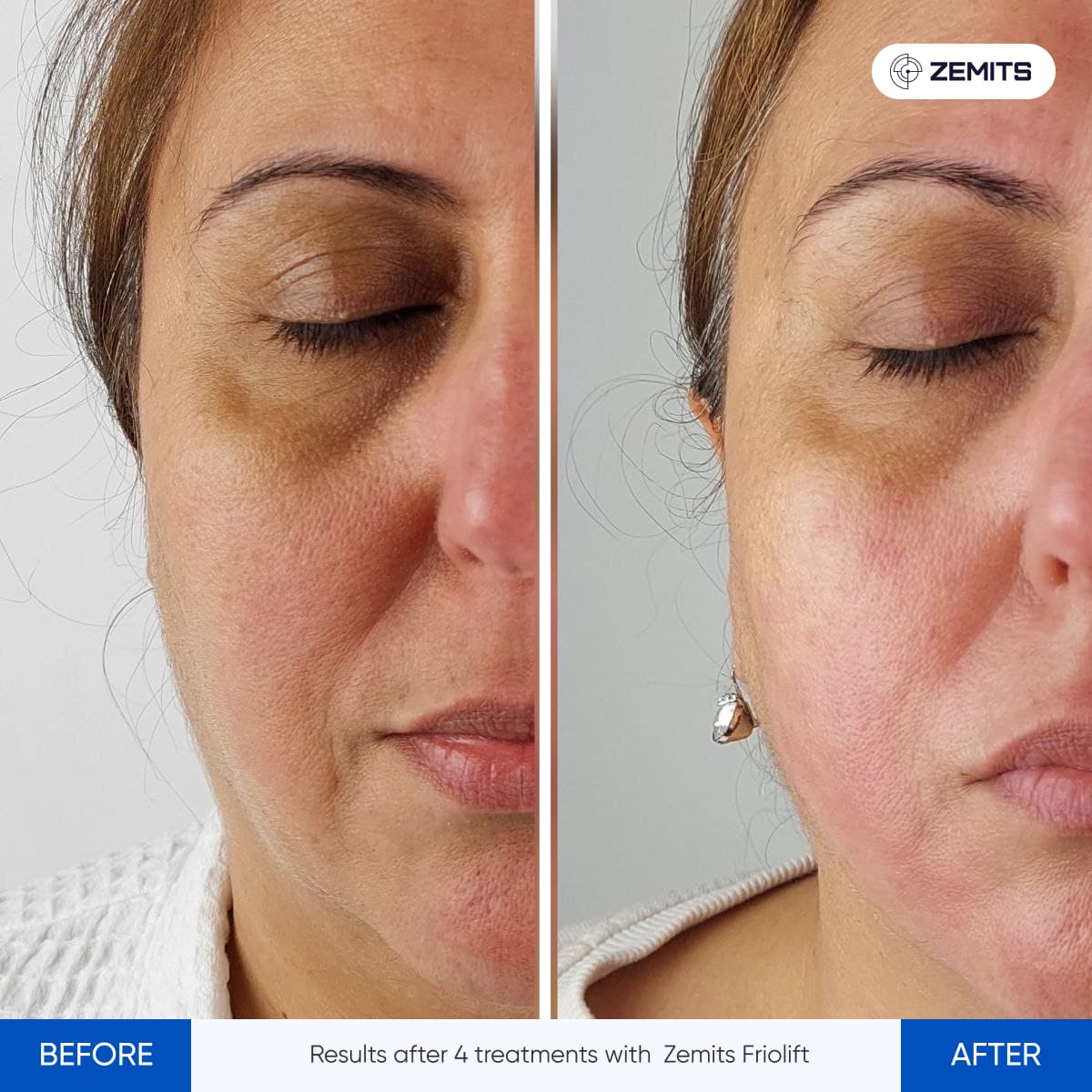 Before After Slide 13