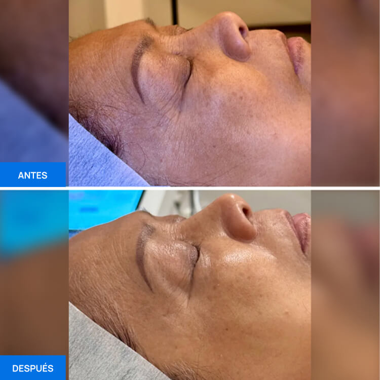 Zemits OxiVelour Pro