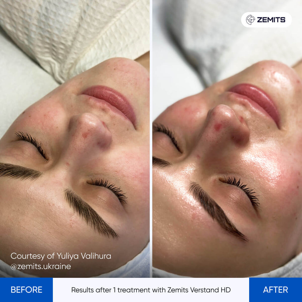 Before and after facial treatment results Zemits Verstand HD