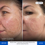 Before and after RF microneedling results Zemits SkyFrax Pro