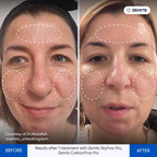 Before and after RF microneedling results Zemits SkyFrax Pro