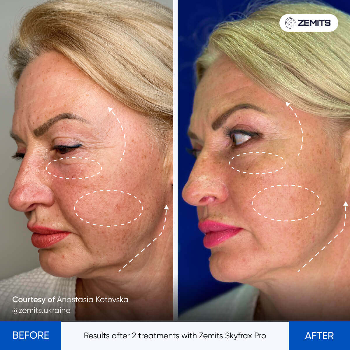 Before After Slide 2