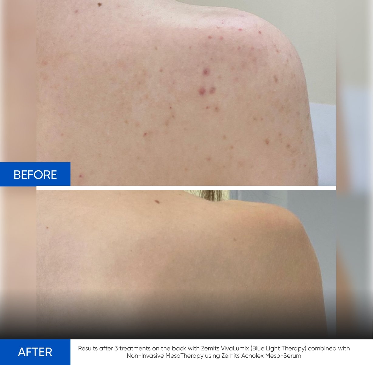 Before and after LED light therapy results Zemits VivaLumix