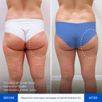 Before and after contouring results Zemits EndoLuxx Pro