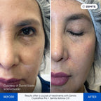 Before and after microcurrent therapy results Zemits Adrinox 2.0
