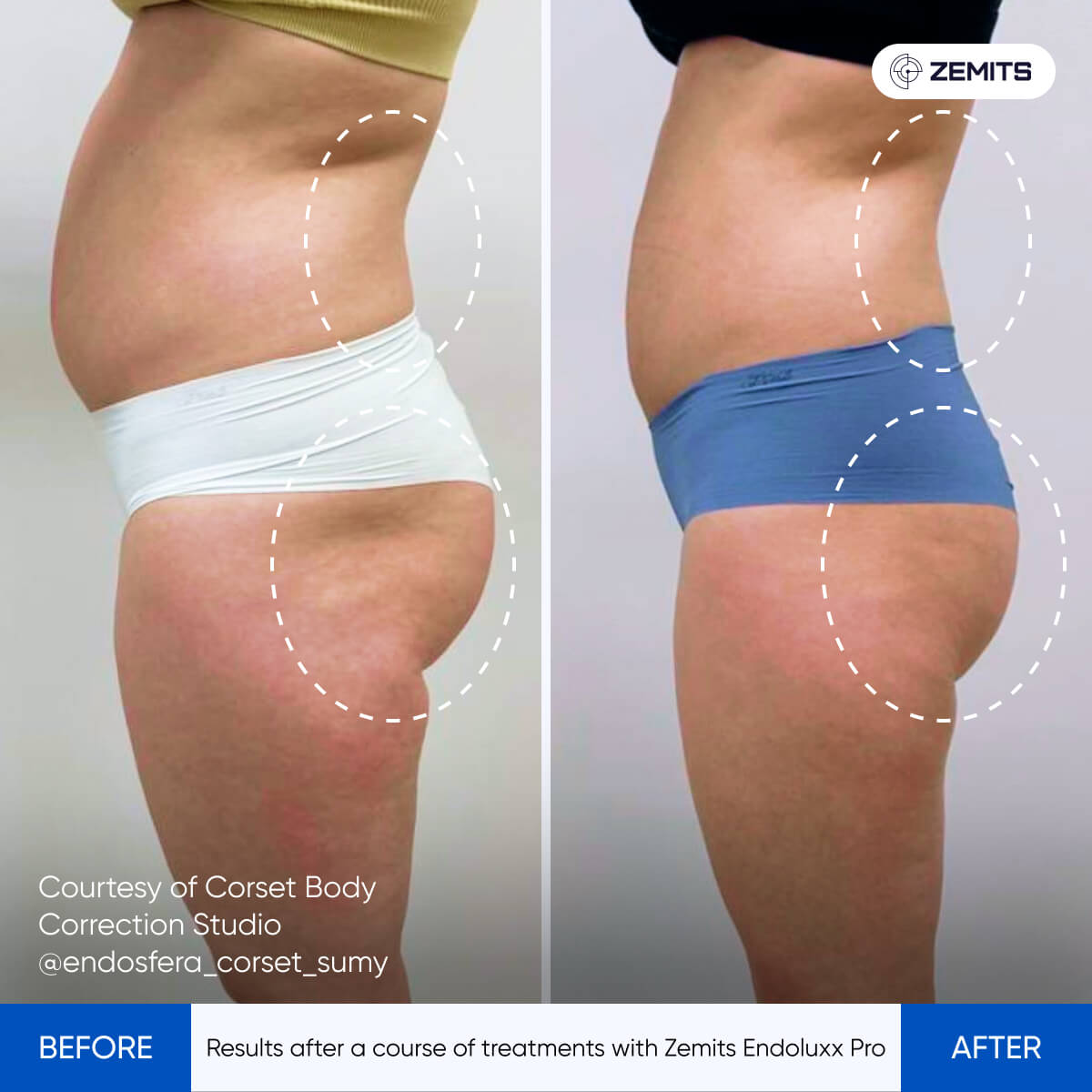 Before and after contouring results Zemits EndoLuxx Pro
