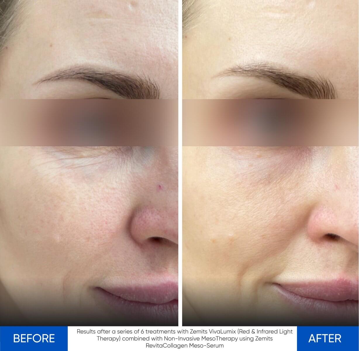 Before and after LED light therapy results Zemits VivaLumix