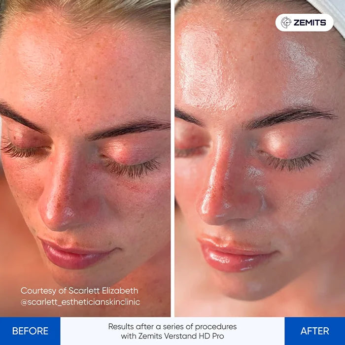 Before and after facial treatment results Zemits Verstand HD