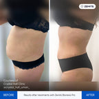 Before and after body contouring results Zemits Bionexis Pro