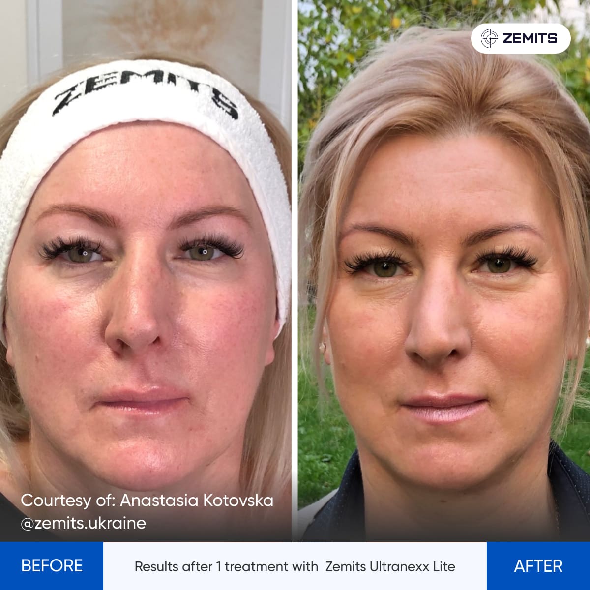 Before and after HIFU facelift results Zemits UltraNexx Lite