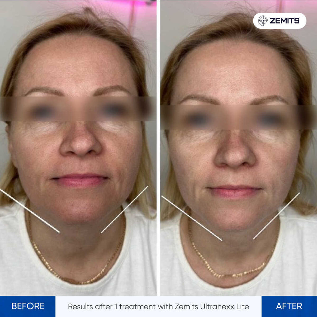 Before and after HIFU facelift results Zemits UltraNexx Lite