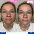 Before and after HIFU facelift results Zemits UltraNexx Lite