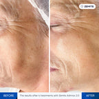 Before and after microcurrent therapy results Zemits Adrinox 2.0
