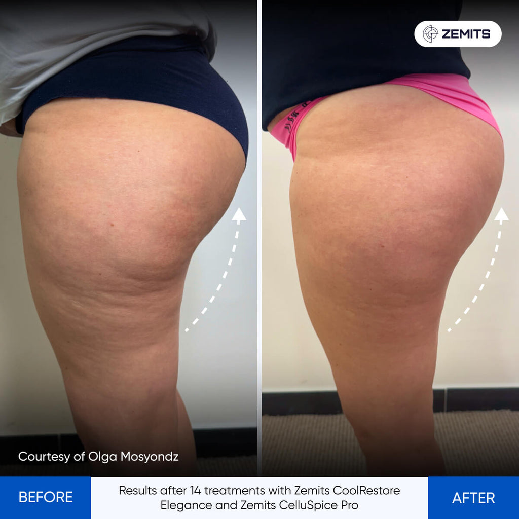 Before and after cellulite reduction results Zemits CelluSpice Pro