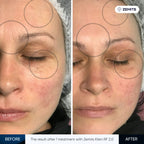 Before and after radiofrequency results Zemits Klein RF 2.0