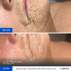 Before and after microcurrent therapy results Zemits Adrinox 2.0