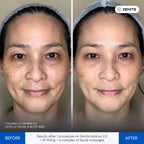 Before and after microcurrent therapy results Zemits Adrinox 2.0