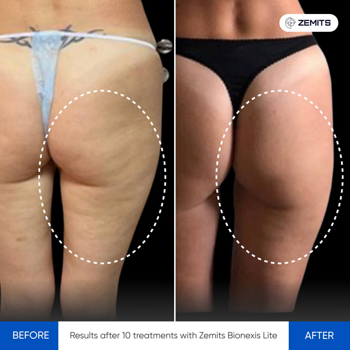 Before and after body sculpting results Zemits Bionexis Lite