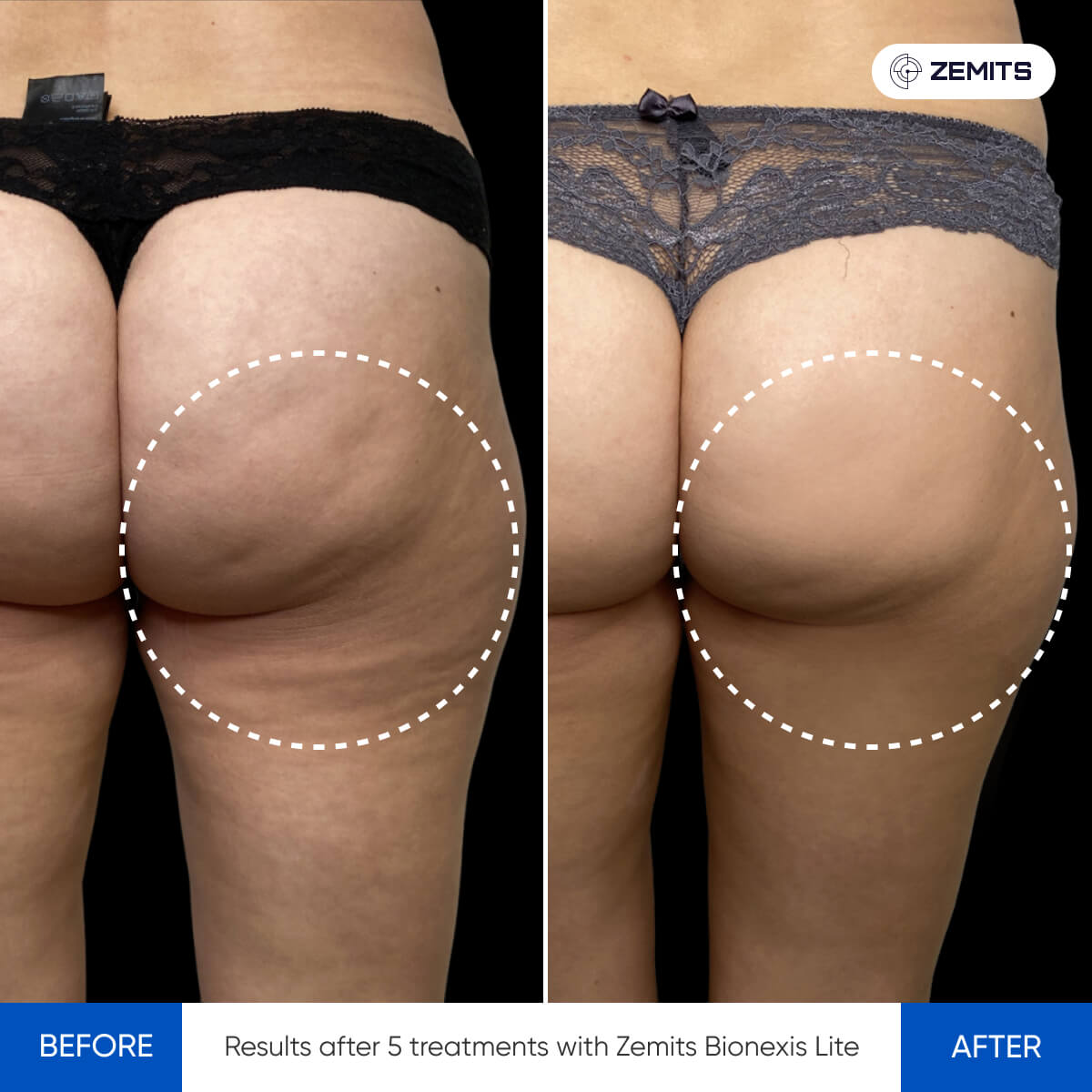 Before and after body sculpting results Zemits Bionexis Lite