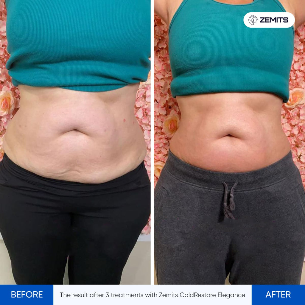 Before and after cryotherapy results Zemits ColdRestore Elegance