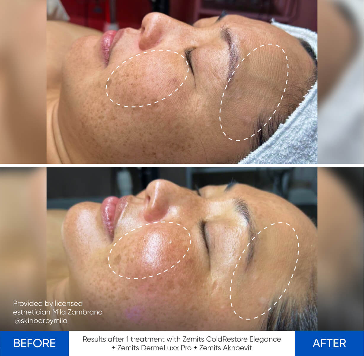 Before and after body sculpting results Zemits Abigon Pro