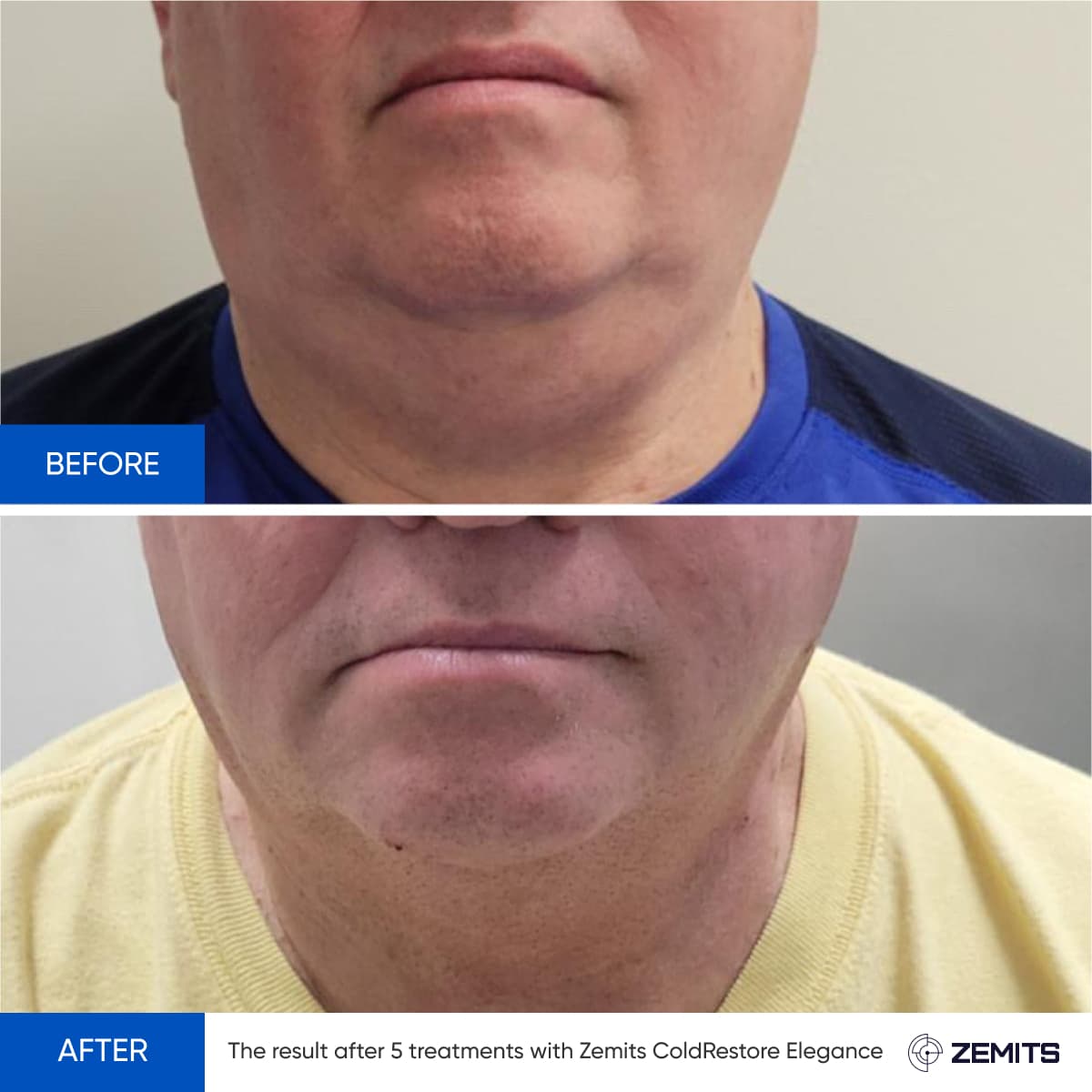 Before and after cryotherapy results Zemits ColdRestore Elegance