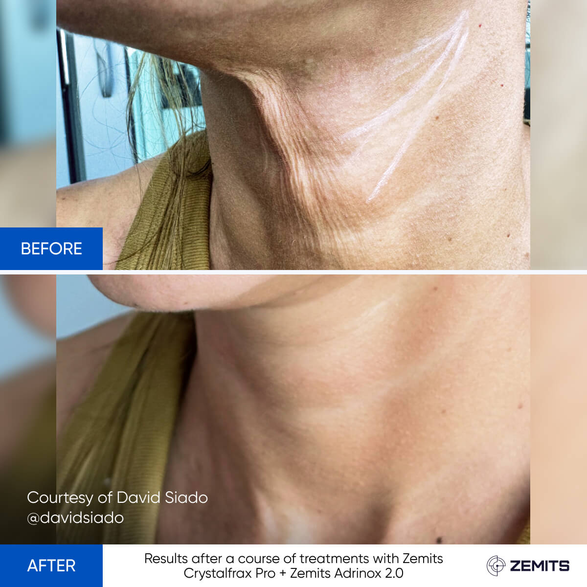 Before After Slide 17