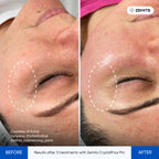 Before and after fractional RF treatment results CrystalFrax Pro