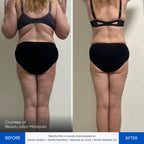 Before and after pressotherapy results Zemits Demeter 2.0