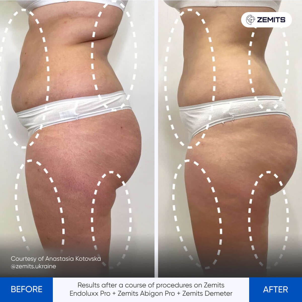 Before and after pressotherapy results Zemits Demeter 2.0