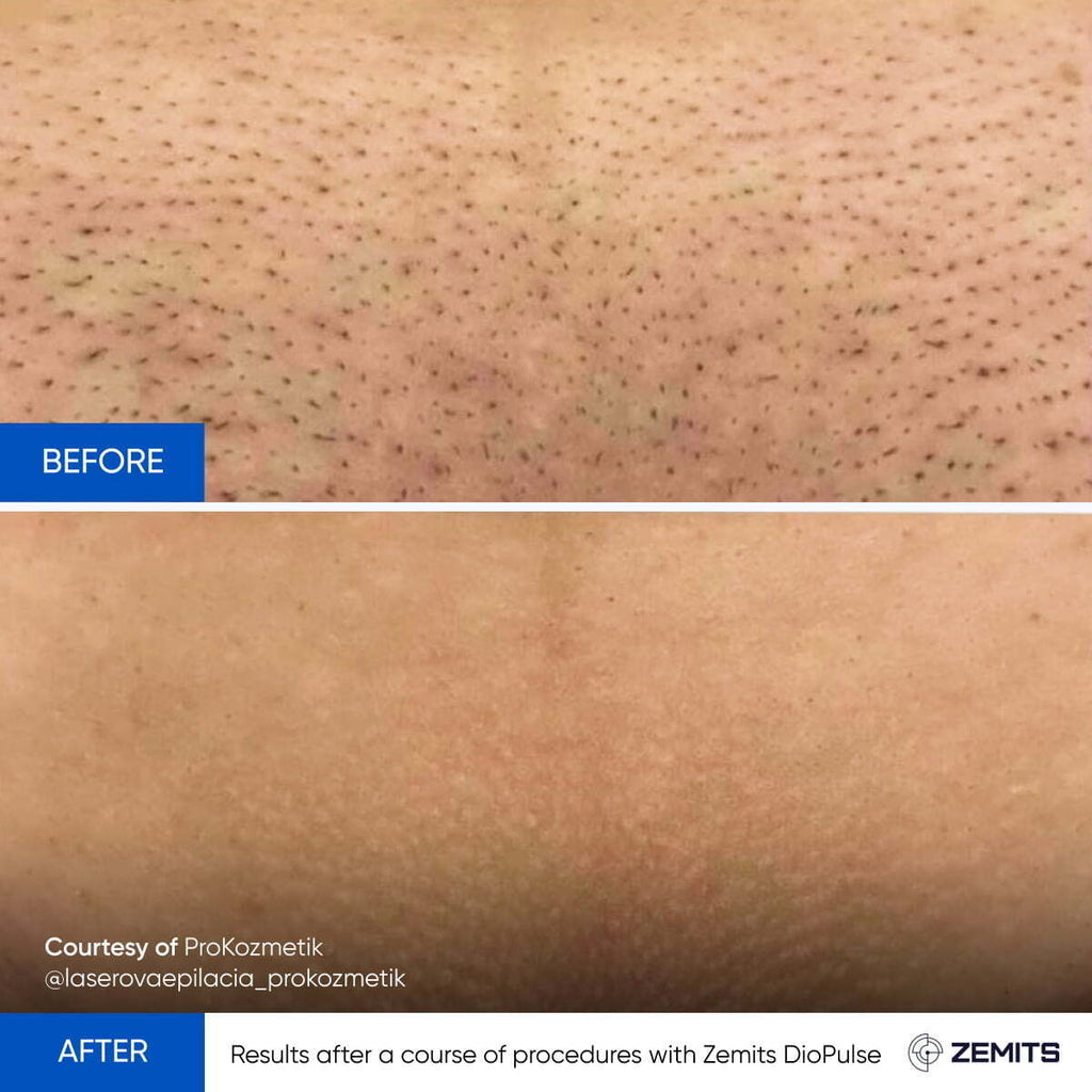 Before and after laser hair removal results Zemits DioPulse