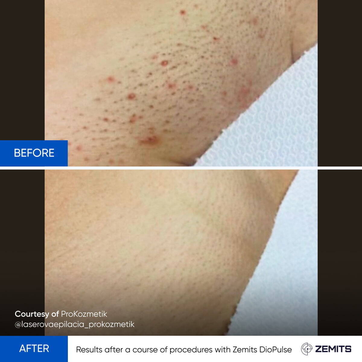 Before and after laser hair removal results Zemits DioPulse