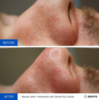 Before and after hydrodermabrasion results Zemits Eau Sante