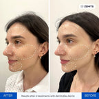 Before and after hydrodermabrasion results Zemits Eau Sante