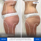 Before and after contouring results Zemits EndoLuxx Pro