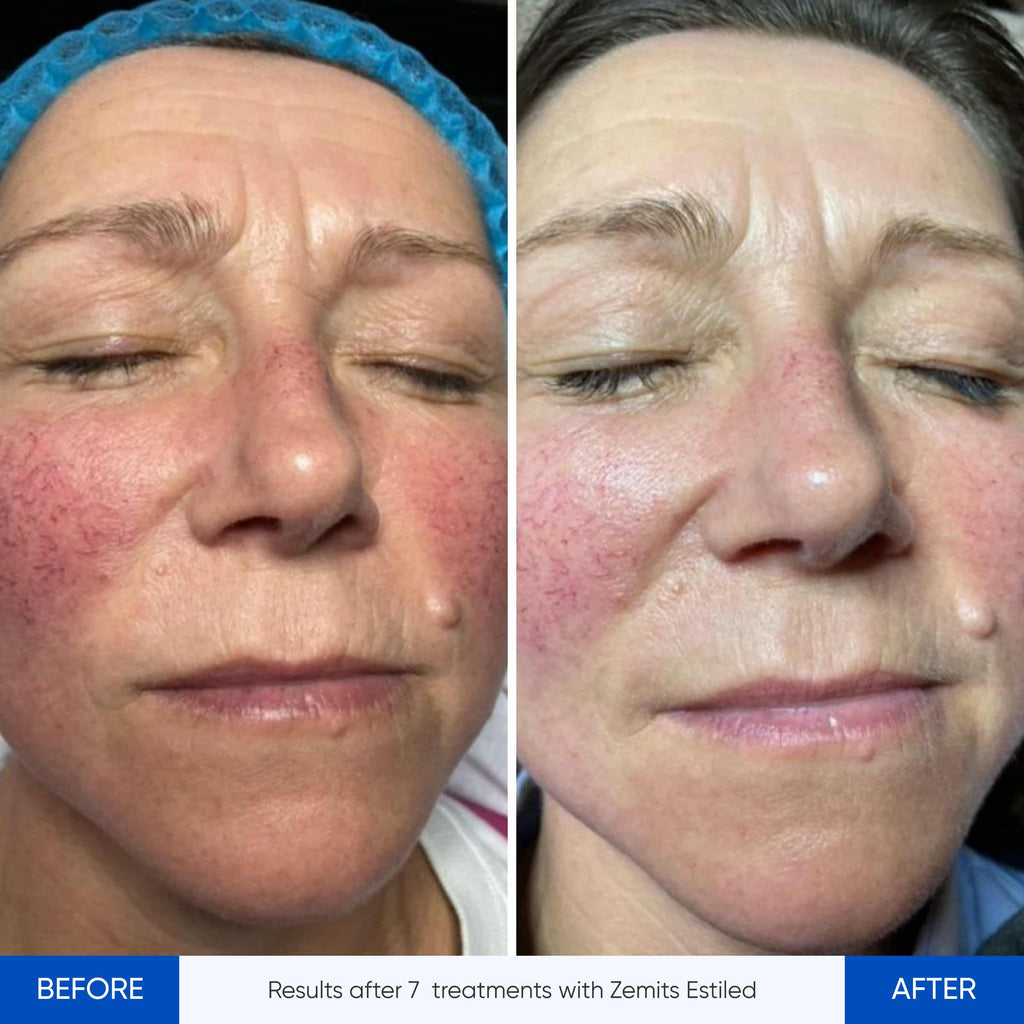 Before and after LED therapy device Zemits Estiled