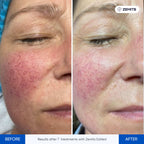 Before and after LED therapy device Zemits Estiled