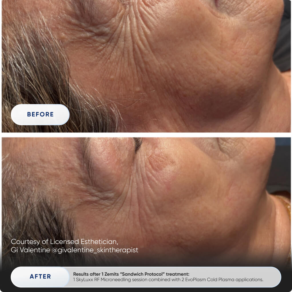 Zemits EvoPlasm