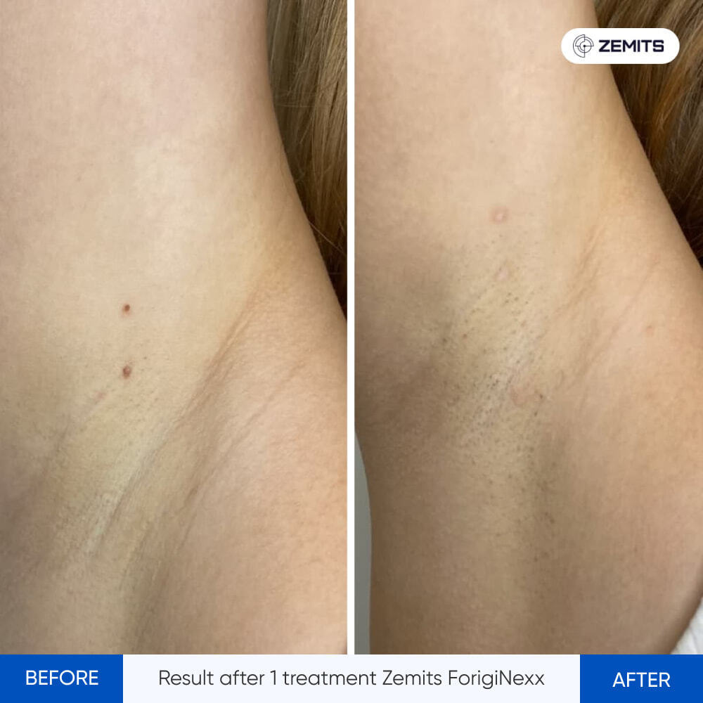 Before and after electrolysis results Zemits ForigiNexx