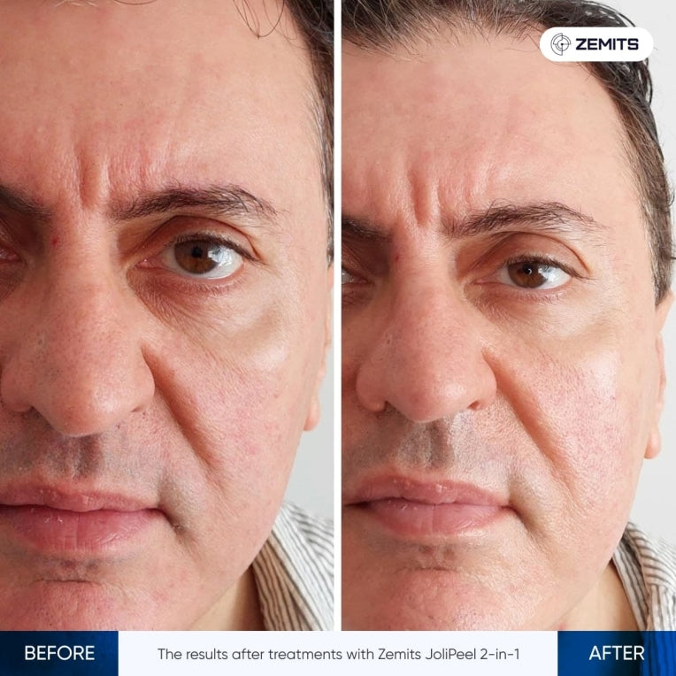 Before and after microdermabrasion results Zemits JoliPeel