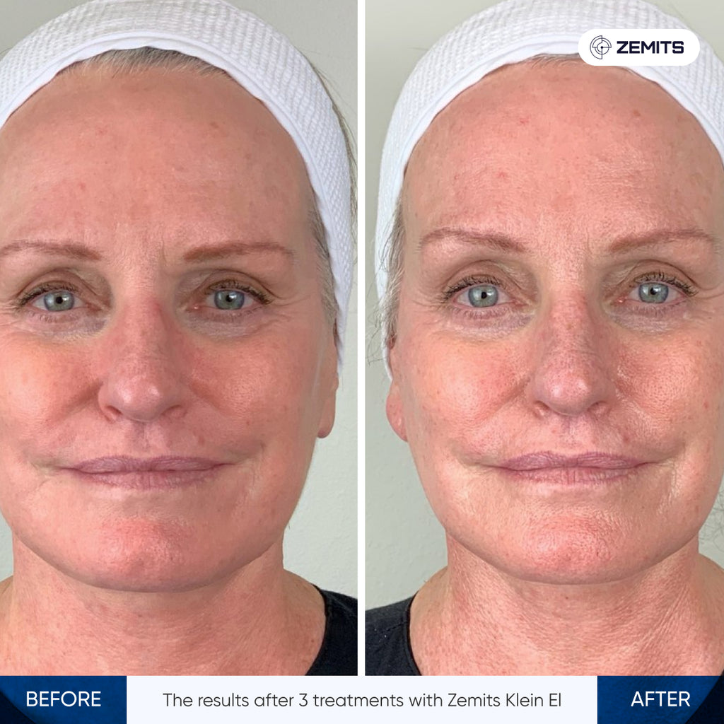 Before and after electroporation results Zemits Klein EL