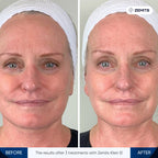 Before and after electroporation results Zemits Klein EL